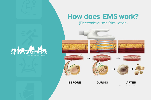 EMS treatment for post pregnancy weight loss treatment Sighthill