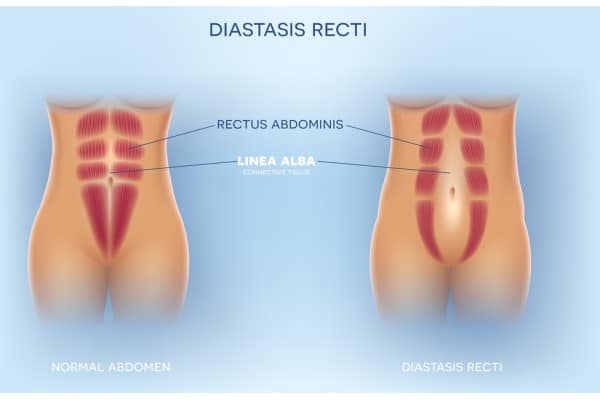 What Non-Surgical Options Are Available for Diastasis Recti Sighthill?