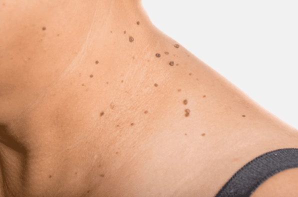 Are you looking for easy skin tag removal Sighthill - then contact Spire today!