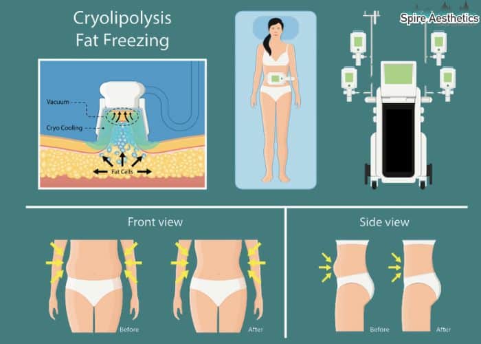 Image of diet and fat freezing combined for best results for Spire Aesthetics Sighthill