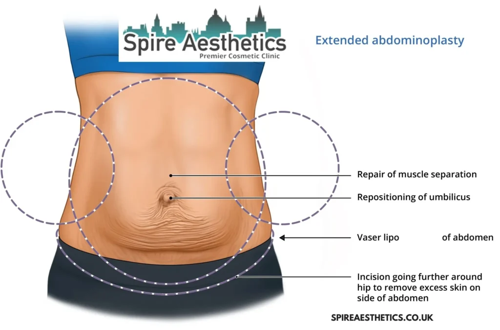 Understanding Loose Skin After Gastric Band Sighthill Surgery and HIFU Treatment