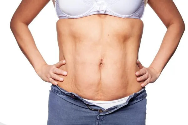 sagging skin on woman's stomach after weight loss injections Sighthill