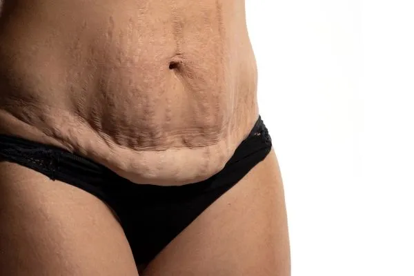 Image of womans stomach after weight loss injections Sighthill showing saggy skin